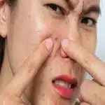 How to Control Excess Sebum During Monsoon Season