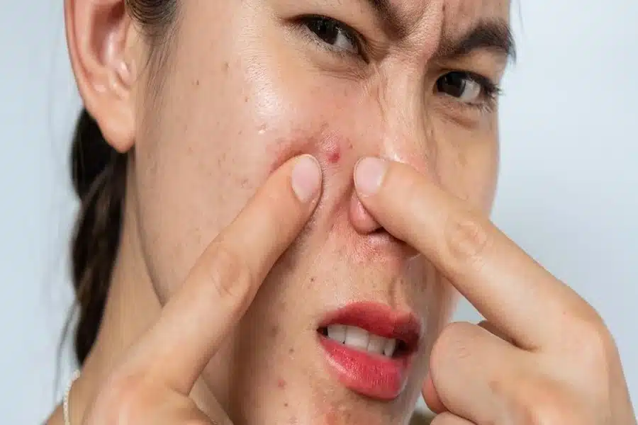 How to Control Excess Sebum During Monsoon Season