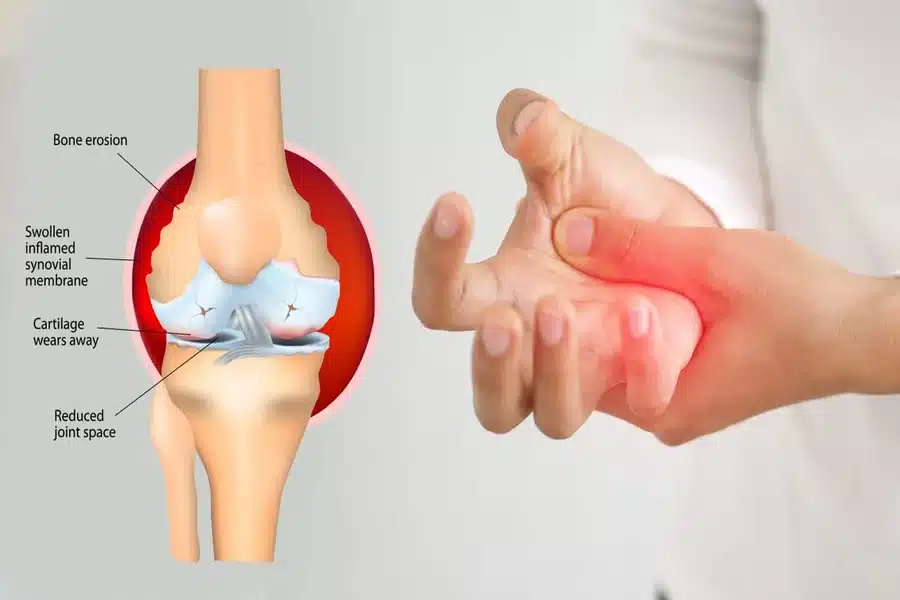 Understanding Autoimmune Arthritis What Your Body Might Be Telling You