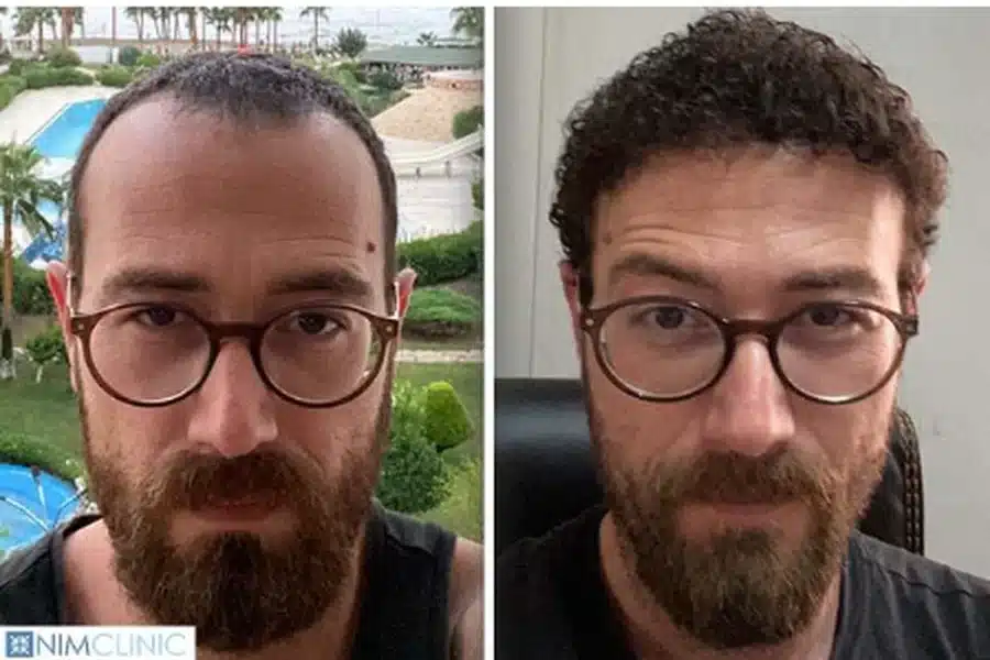 Hair Transplant