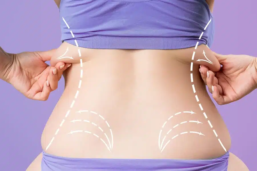 How Lifestyle Habits Influence Long-Term Liposuction Results