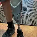 Custom Prosthetic